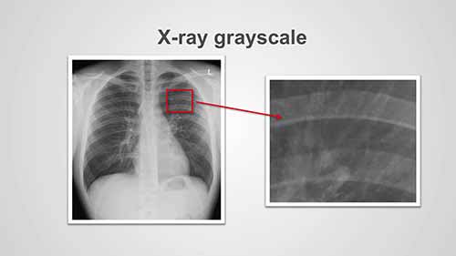 了解胸部X光——灰度的重要性