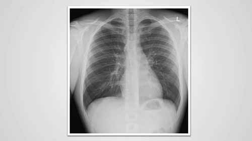 了解胸部X光——病理与灰度变化