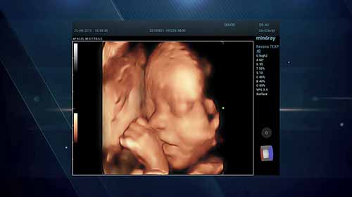 三维四维胎儿超声影像